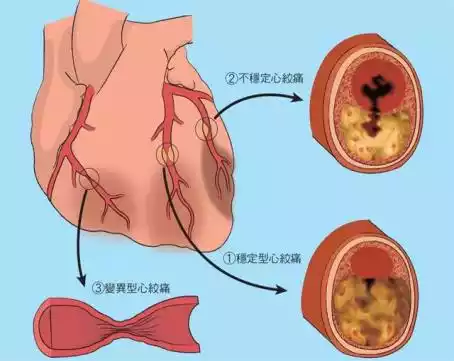 常见的异常心电图波形识别_异常心电图波形_心电图什么是异常q波