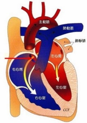 心脏缺电如何解决_心脏缺电是怎么回事_心脏房缺心功能一级能进电网吗