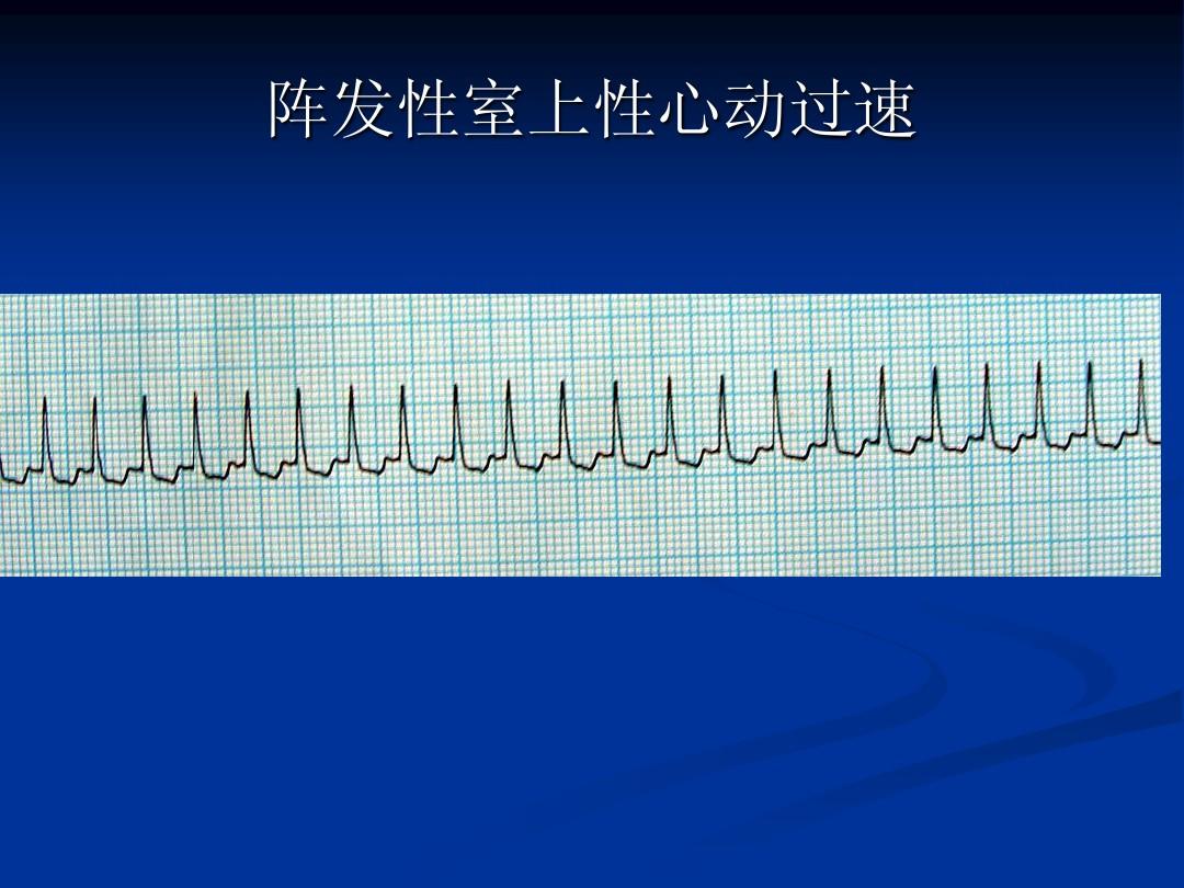 心律失常阵发性房性心动过速_性心动阵室异常发过高烧_阵发性室上性心动过速 异常q