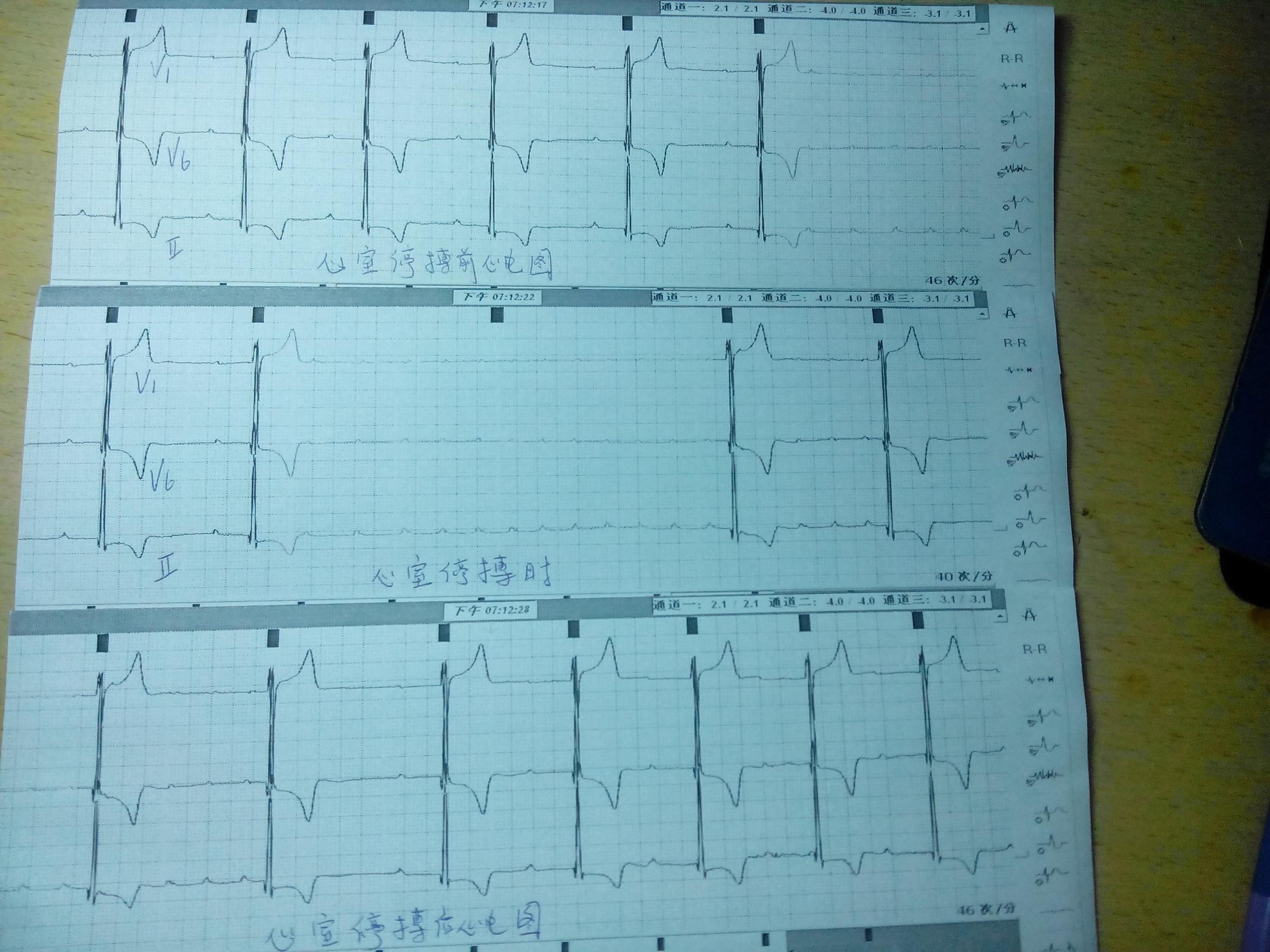 性心动阵室异常发过高烧_阵发性室上性心动过速 异常q_心律失常阵发性房性心动过速