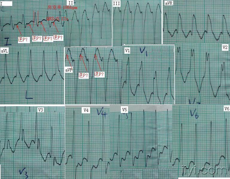 阵发性室上性心动过速 异常q_心律失常阵发性房性心动过速_性心动阵室异常发过高烧
